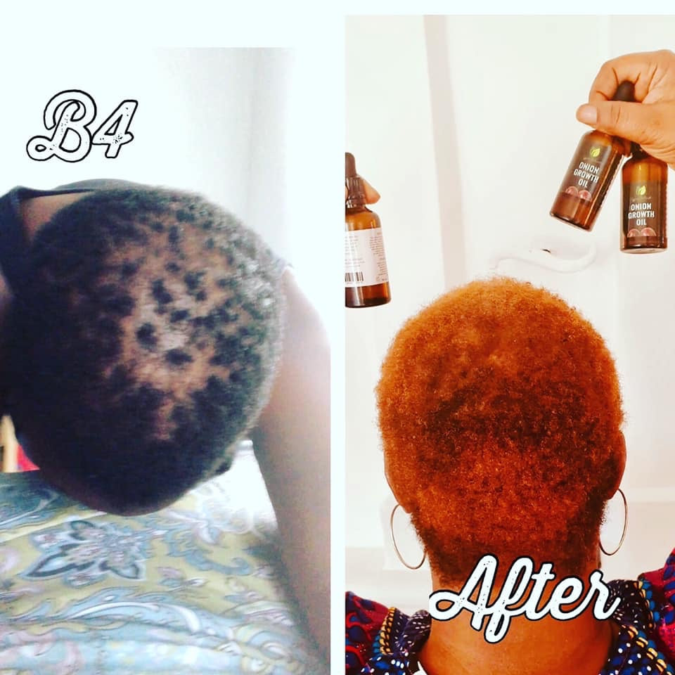 **Zyzven Naturals & NAFI Onion Growth Oil - En naturlig lösning för håråterväxt**
50 ml