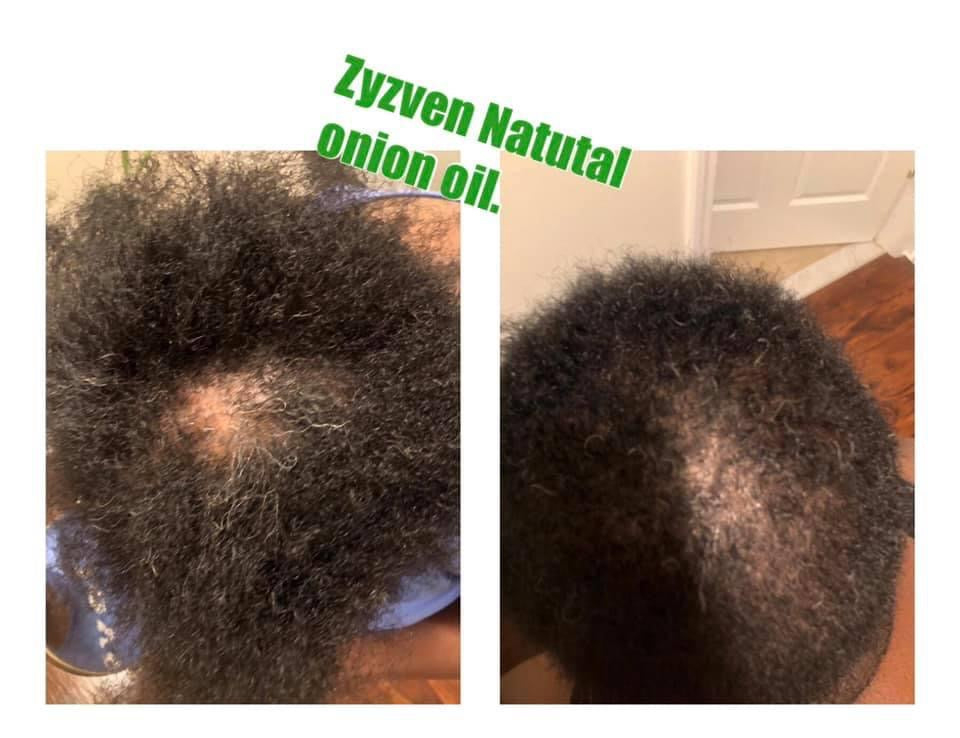 **Zyzven Naturals & NAFI Onion Growth Oil - A Natural Solution for Hair Regrowth**
 50ml